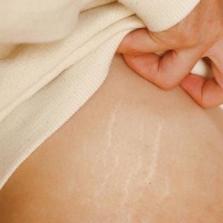 ženska ruka podiže majicu da bi pokazala strije na svom telu