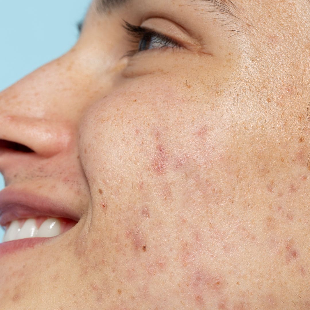akne-i-oziljci-od-akni-na-licu.jpg